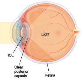 Cross section of eye showing light shining through IOL and clear posterior capsule.