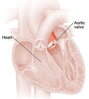 Cross section of heart showing aortic valve with insufficiency. 
