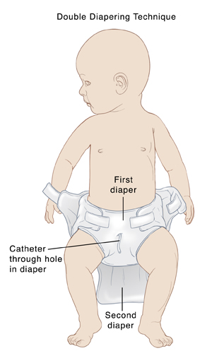 Baby with two diapers and catheter showing double diapering technique.