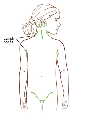 Outline of child showing lymph nodes in front of and behind ear, on side and back of neck, under chin, in armpits, and in groin.