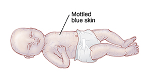 Baby with mottled blue skin.