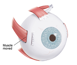 Three-quarter view of eye showing muscle on outside of eye. Muscle has been cut, moved back, and sutured to sclera.