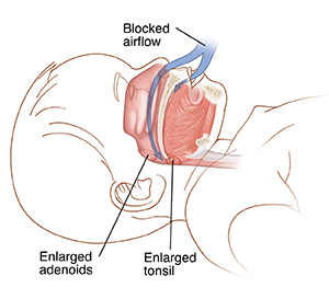 Outline of child's head showing enlarged adenoids and enlarged tonsil. Arrow shows enlarged adenoids and tonsils blocking airflow.