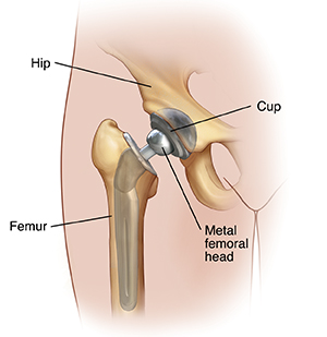 Front view of hip joint showing total hip replacement.