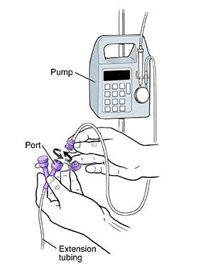 Closeup of hands connecting feeding bag tubing to port on extension tubing. Feeding bag tubing is connected to pump.