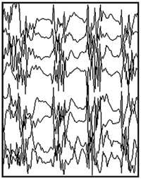 Registro de EEG con convulsiones generalizadas.