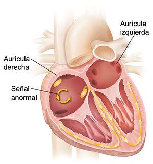 Corte transversal de un corazón con aleteo auricular.