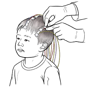 Manos de un proveedor de atención médica que coloca discos para realizar un electroencefalograma en la cabeza de un niño pequeño. Los discos están conectados a cables.