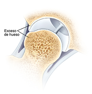 Corte transversal de una articulación de cadera en donde se ve un bulto anormal formado por exceso de hueso en la cabeza del fémur. También se ve exceso de hueso en el reborde de la cavidad.