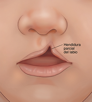 Primer plano de un bebé con labio leporino parcial.