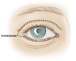 Vista frontal de un ojo mostrando una línea punteada encima del párpado y una línea punteada debajo de las pestañas inferiores para una cirugía de párpados.