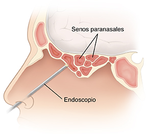 Vista lateral de la cabeza donde se ven los senos paranasales inflamados y la introducción del endoscopio por la nariz.