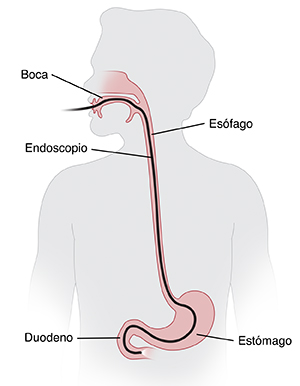 Esquema de la cabeza y el tórax con el endoscopio en la boca y el esófago. El endoscopio termina en la primera parte del intestino delgado.