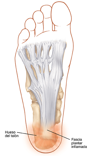 Vista inferior de un pie donde pueden verse los huesos y la fascia plantar con fascitis plantar.