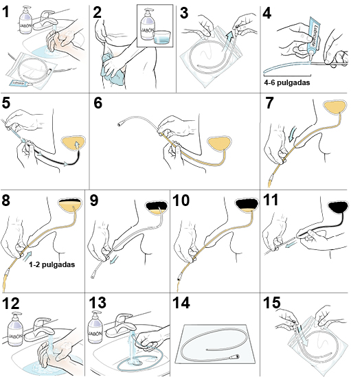 15 pasos para saber cómo se inserta un catéter urinario masculino.