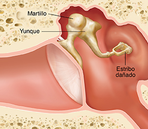 Corte transversal de un oído donde pueden verse las estructuras del oído externo, interno y medio, con el estribo dañado.