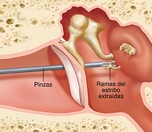Corte transversal de un oído donde pueden verse las estructuras del oído externo, interno y medio, con un instrumento que extirpa el estribo dañado.