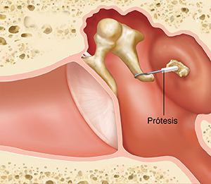 Corte transversal de un oído, donde pueden verse las estructuras del oído externo, interno y medio, con una prótesis que reemplaza el estribo dañado.