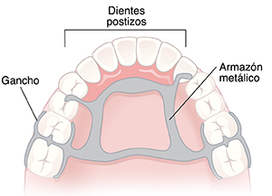 Paladar y dientes, donde puede verse una prótesis dental parcial.