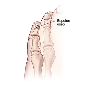 Vista superior del dedo meñique del pie donde se observa un espolón óseo.