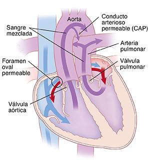 Corte transversal de vista frontal de un corazón en donde se ve las transposición de las grandes arterias. La aorta está encima del ventrículo derecho y la arteria pulmonar está encima del ventrículo izquierdo. También se ve el conducto arterioso permeable y el agujero oval permeable. Las flechas muestran la circulación de la sangre en ambas direcciones entre el lado izquierdo y el derecho del corazón a través del agujero oval permeable. La sangre mezclada sale del corazón a través de la aorta y la arteria pulmonar.