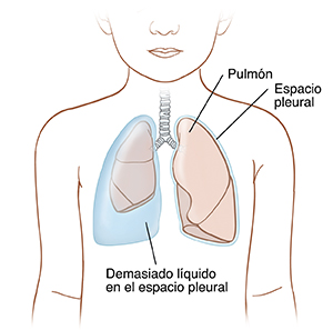 Vista frontal de un niño donde se observa líquido atrapado entre el pulmón comprimido y la pared corporal del lado derecho. A la izquierda se ve un pulmón normal.