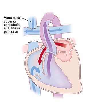 Corte transversal de vista frontal de un corazón en donde se muestra el procedimiento de Glenn bidireccional para tratar un ventrículo izquierdo hipoplásico. La vena cava superior está conectada a la arteria pulmonar. Unas flechas muestran cómo la sangre fluye de la aurícula izquierda al ventrículo derecho y se mezcla con sangre de la vena cava inferior, que luego se bombea hacia afuera de la aorta.