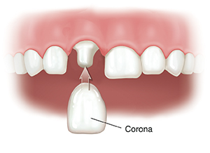 Primer plano de dientes: uno de ellos está tallado. Se está colocando una corona en el diente tallado.