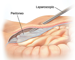 Vista lateral de corte transversal de la parte baja del abdomen donde puede verse un laparoscopio que entra al cuerpo por encima del peritoneo.