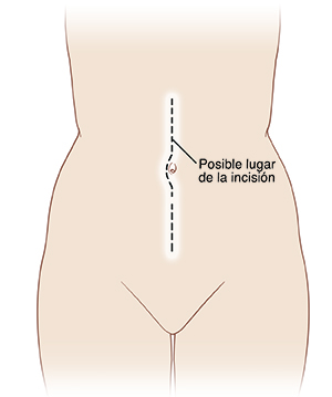 Contorno de una figura humana con una línea en medio del abdomen, que comienza en la parte superior del abdomen, se curva alrededor del ombligo y finaliza en la parte inferior del abdomen.