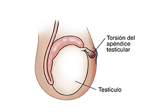 Vista lateral de un testículo donde puede verse un apéndice testicular retorcido.