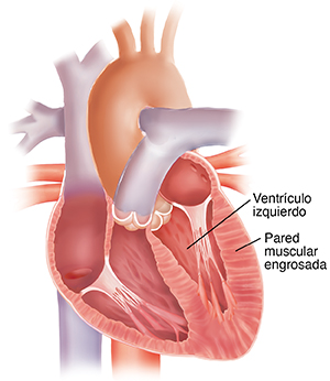 Corte transversal de un corazón con hipertrofia ventricular izquierda. Paredes del ventrículo izquierdo engrosadas.