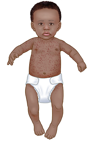 Un bebé con roséola en el cuello, los brazos y el torso.
