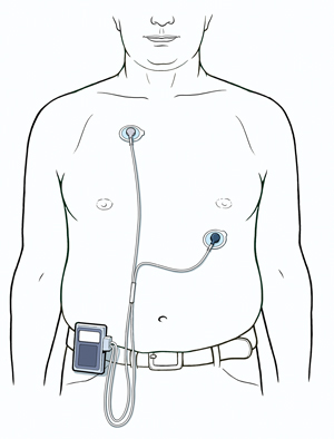 Torso de un hombre que muestra dos cables de electrocardiograma conectados al pecho y a un monitor de eventos sujeto al cinturón.
