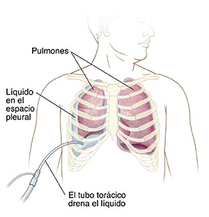 Contorno de un hombre donde puede verse líquido atrapado entre el pulmón colapsado y la pared corporal del lado derecho. Pulmón normal a la izquierda. Tubo insertado en el pecho entre las costillas a la derecha que está eliminando el líquido atrapado.