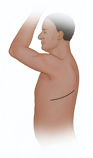 Vista lateral de un torso masculino en el que se muestra el lugar donde puede hacerse la incisión para una toracotomía.