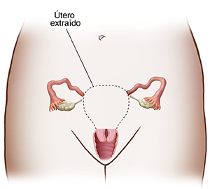 Vista frontal de una pelvis femenina mostrando los órganos reproductores. Un línea punteada alrededor de útero indica una histerectomía subtotal.