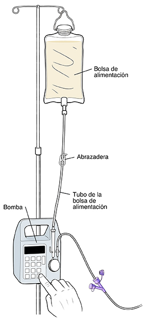 Bolsa de alimentación que cuelga de un soporte de la bomba. Se ven tubos que van de la bolsa a la bomba. Hay una abrazadera en la mitad del recorrido de los tubos.