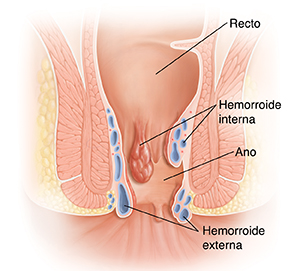 Corte transversal de ano y recto con hemorroides.