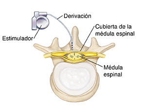 Vista superior de la médula espinal con estimulador.