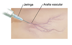 Primer plano de aguja insertada en una araña vascular.