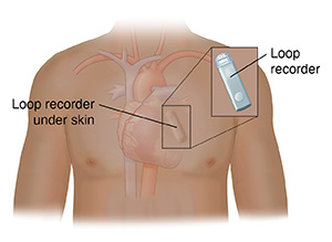 Vista frontal del pecho de una persona que muestra el corazón y registrador de bucle debajo de la piel por encima del corazón. Un diagrama muestra el primer plano del registrador de bucle.